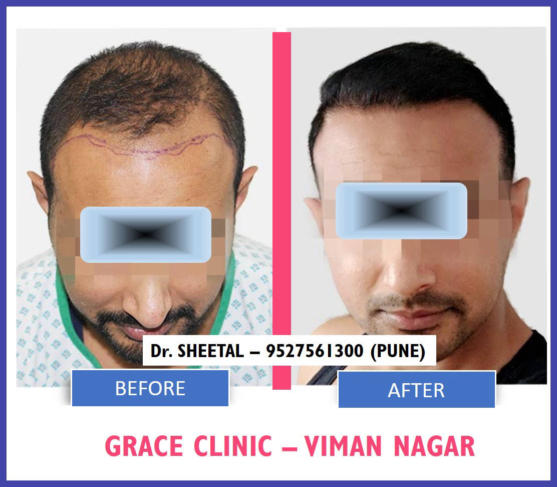 Scala Skin  Hair Transplant in Dwaraka Nagar VisakhapatnamVisakhapatnam   Best Skin Care Clinics in Visakhapatnam  Justdial